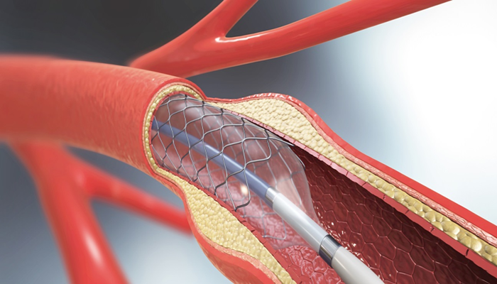 Angioplasty